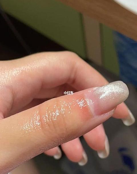 用热水烫手了怎么办